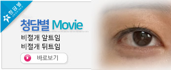 비절개 눈성형-…