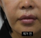 팔자, 입가 이…