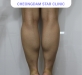 종아리신경차…
