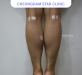 종아리신경차…