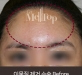 이물질제거 전…