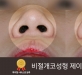 비절개코성형 …