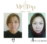 아큐스컬프 3일…