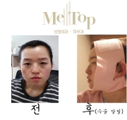 아큐스컬프+코+…
