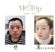 아큐스컬프+코+…