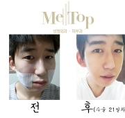 아큐스컬프+미…