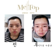 아큐스컬프+코+…