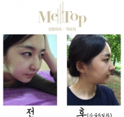 코수술(5일)