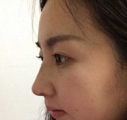 코수술(다음날)