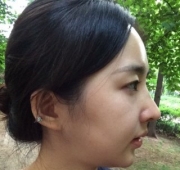 코수술(5일)