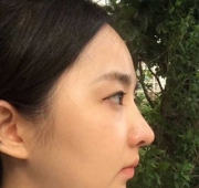 코수술(7일)