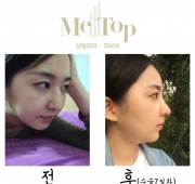 코수술(7일)