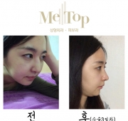 코수술(3일)