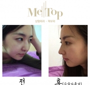 코수술(다음날)