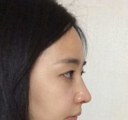 코수술(3일)