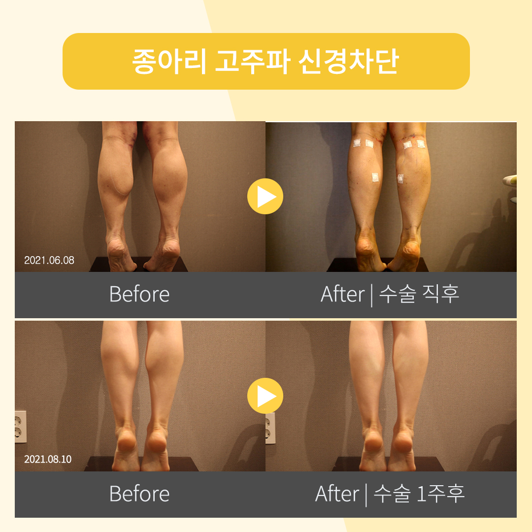 종아리신경차단