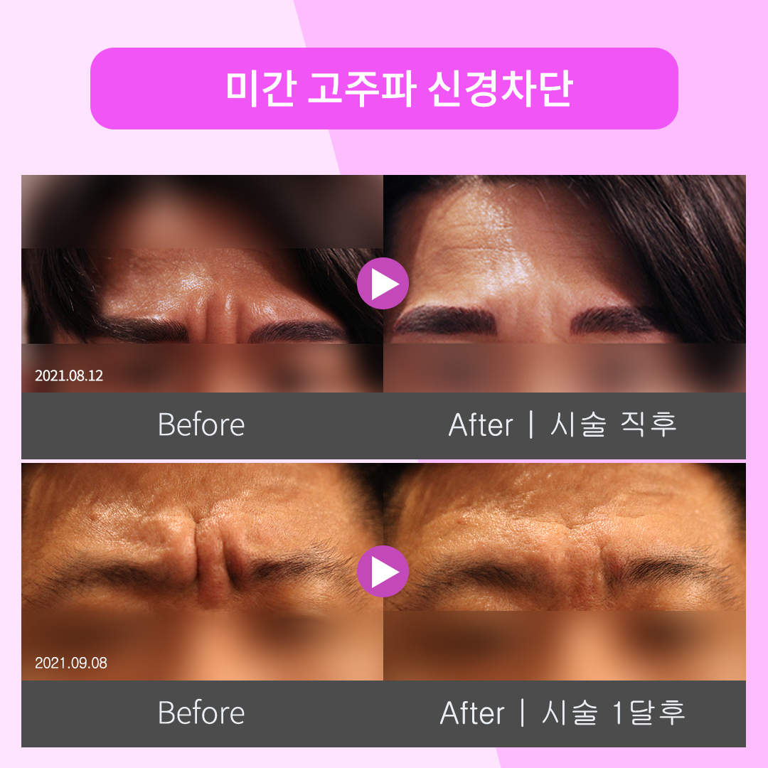 미간신경차단