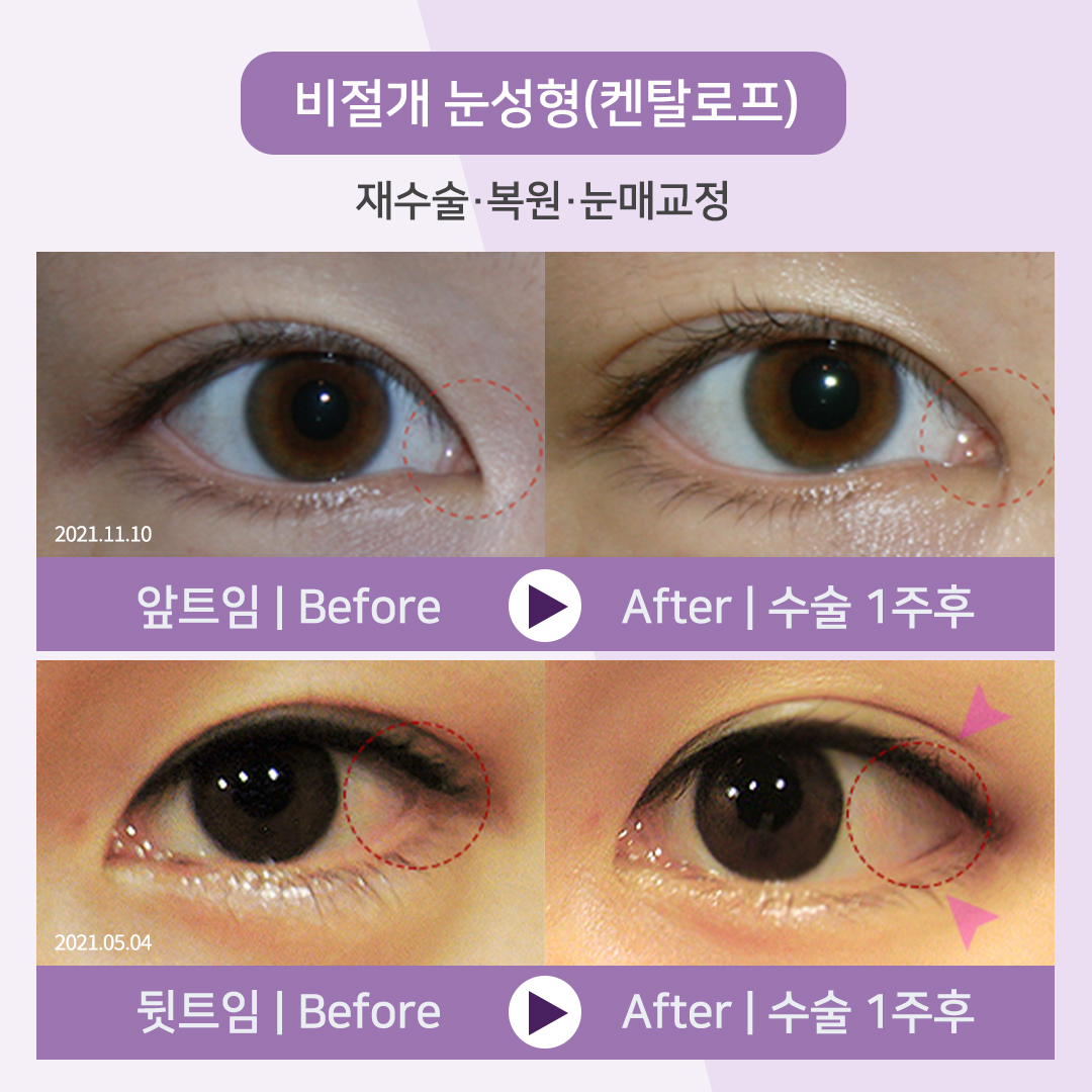 눈성형